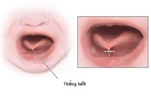 Dính thắng lưỡi ở trẻ